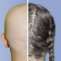 Exploring Minoxidil for Hair Regrowth: What You Need to Know