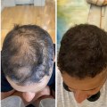 Utilizing Scalp Camouflage Techniques to Create the Illusion of Thicker Hair