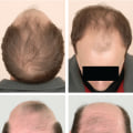 Recognizing Hormonal Changes and Male Pattern Baldness