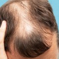 Identifying Lifestyle Factors That Increase the Risk of Male Pattern Baldness