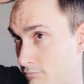 Incorporating Lifestyle Changes to Prevent Male Pattern Baldness