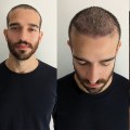 Hair Transplants for Permanent Hair Restoration: A Comprehensive Guide