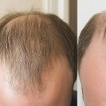 Understanding Finasteride for Male Pattern Baldness