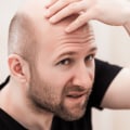 Understanding the Genetic Component of Male Pattern Baldness