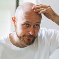 Exploring Medical Treatment Options for Male Pattern Baldness