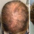 Utilizing Scalp Treatments for Hair Regrowth