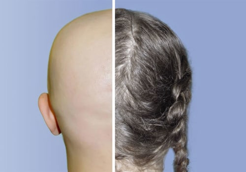 Exploring Minoxidil for Hair Regrowth: What You Need to Know