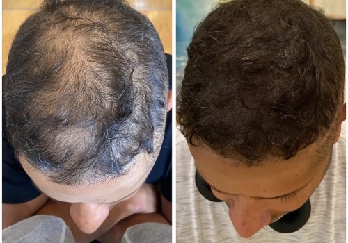 Utilizing Scalp Camouflage Techniques to Create the Illusion of Thicker Hair