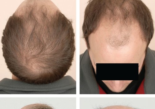 Recognizing Hormonal Changes and Male Pattern Baldness