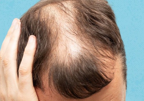Identifying Lifestyle Factors That Increase the Risk of Male Pattern Baldness
