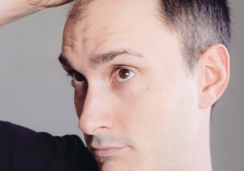 Incorporating Lifestyle Changes to Prevent Male Pattern Baldness