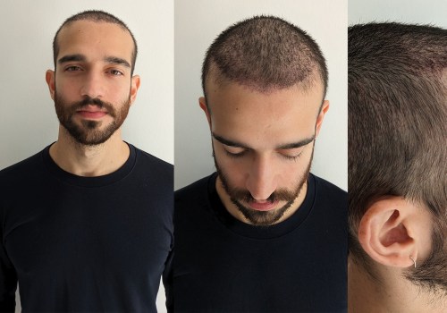 Hair Transplants for Permanent Hair Restoration: A Comprehensive Guide