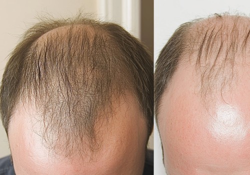 Understanding Finasteride for Male Pattern Baldness