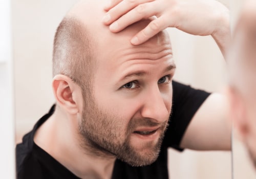 Understanding the Genetic Component of Male Pattern Baldness
