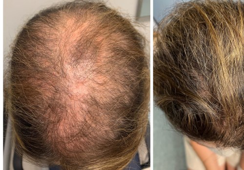 Utilizing Scalp Treatments for Hair Regrowth